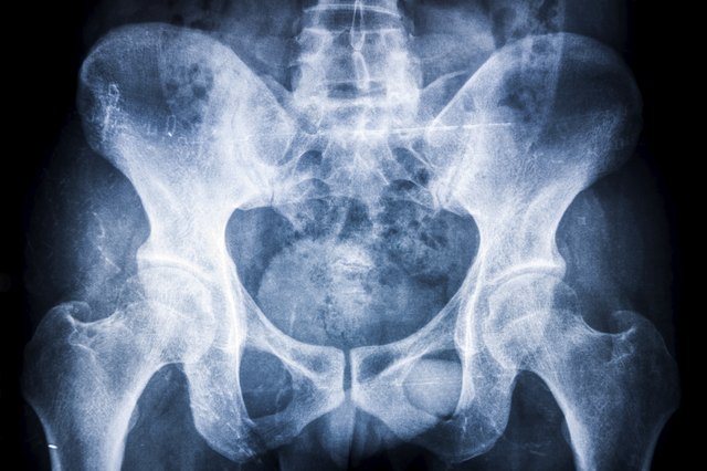 hip xray:fankylosing spondylitis (AS) in sacroiliac articulation