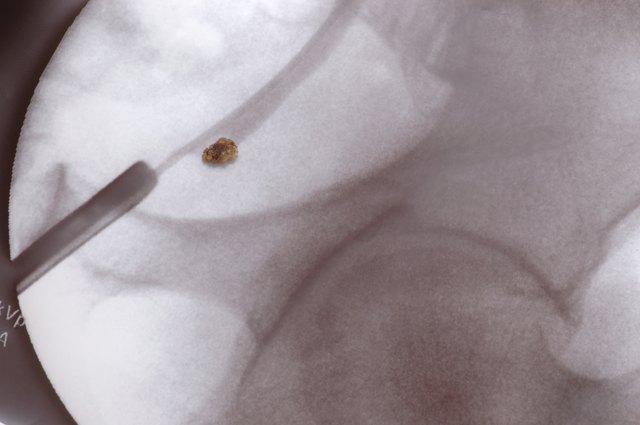 Kidney Stone Positioned on X-ray