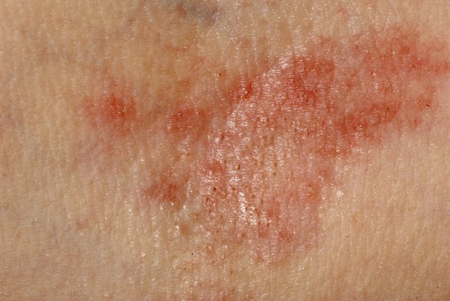 Side Effects Of Vitamin B Hives Rash And Heat