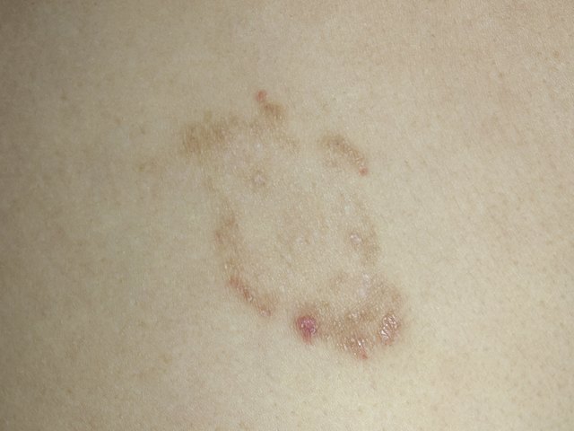 ringworm