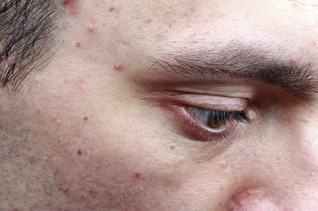 Acne pimples on the face