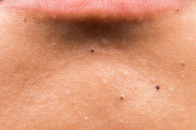 what can get rid of black spots on face