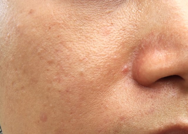 Woman with oily skin and acne scars
