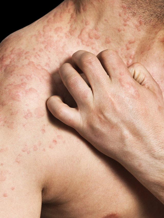 common-shingles-rash-sites-livestrong