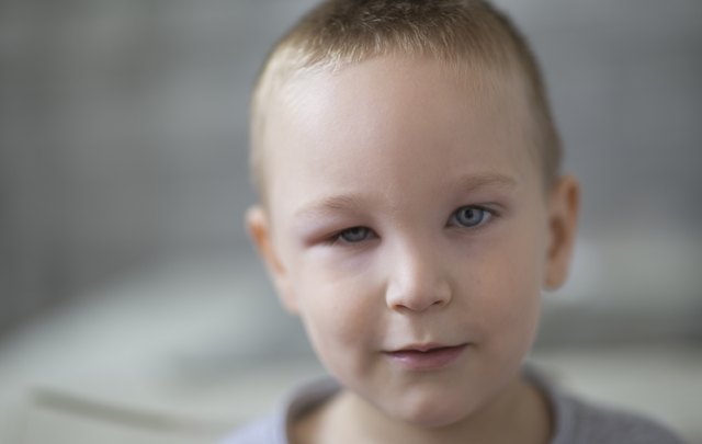 a-swollen-eyelid-in-a-child-livestrong