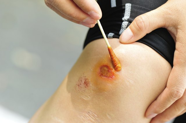 cleaing sports injured knee with medical cotton bud