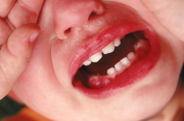 What Causes Swollen Gums In Babies