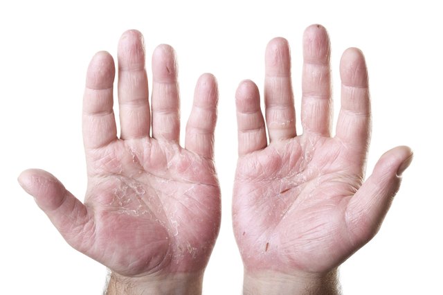 two male palms with eczema isolated on white background