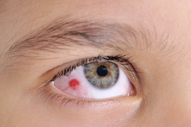 Infected eye