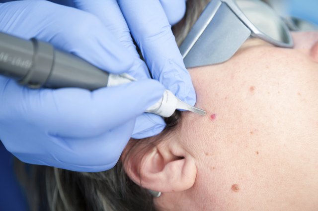 Recovery After V Beam Laser Acne Treatment | Livestrong.com