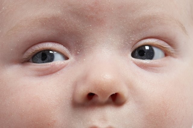 Red Bumps On Baby Face Neck And Chest