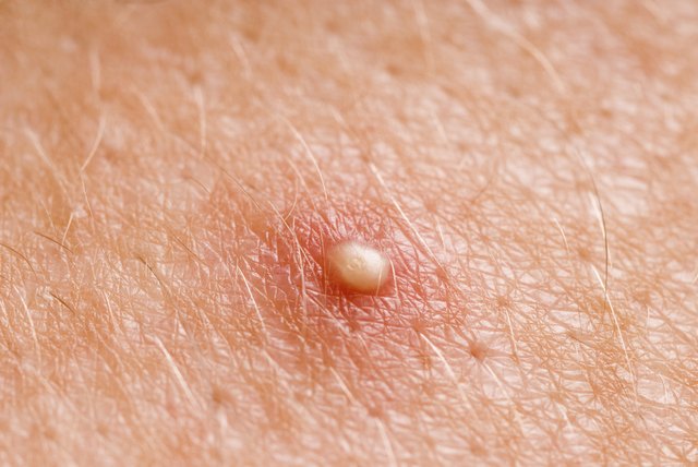 whitehead zit