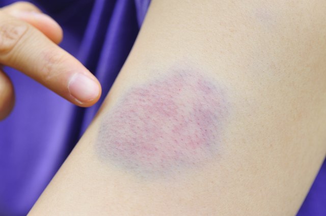 How To Remove Bruise Marks