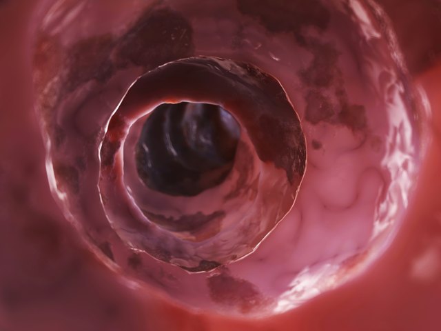unhealthy colon