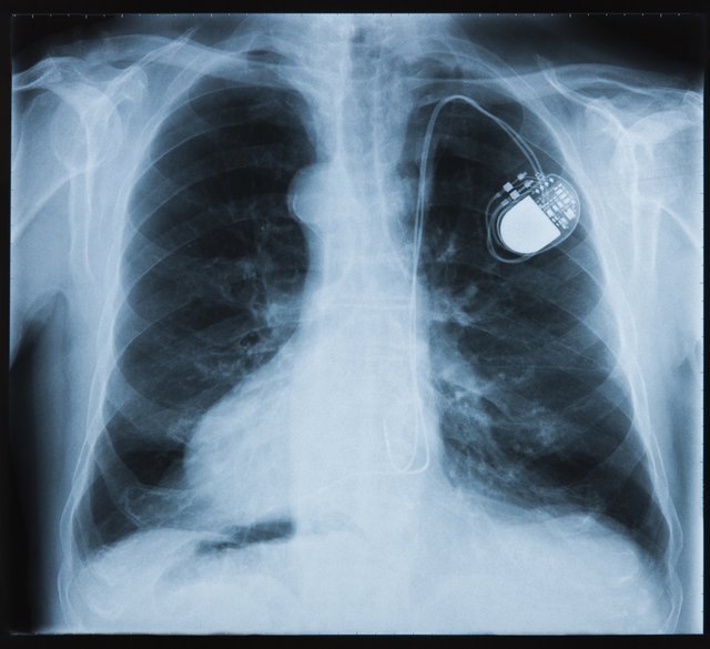 what-are-the-benefits-of-a-pacemaker-livestrong