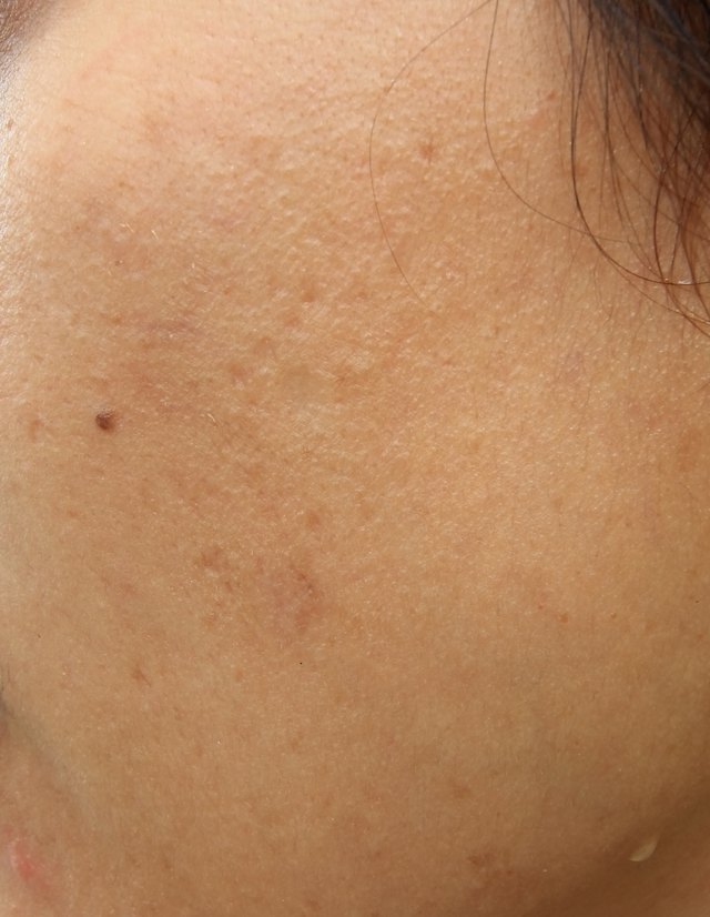 Woman with oily skin and acne scars
