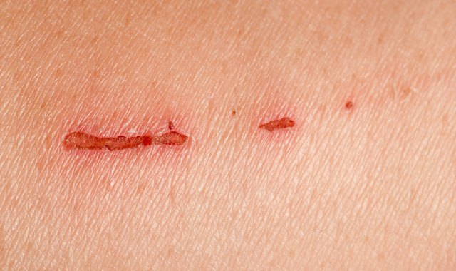 burn scar that is partly healed