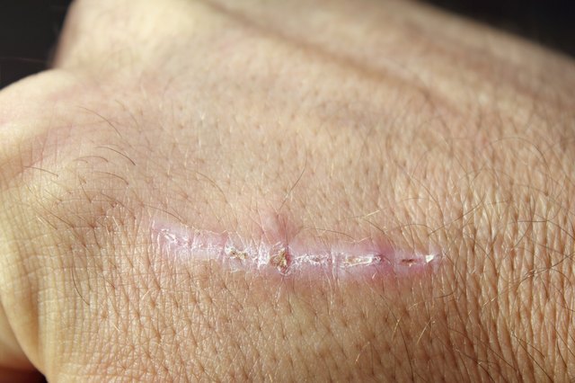 how-to-remove-redness-from-scars-livestrong