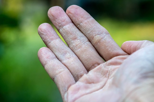Male Hand with Ecxema
