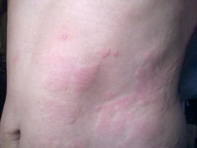 Urticaria (hives)