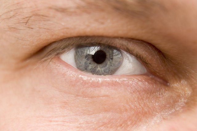 Does Too Much Vitamin D Cause Eye Twitching Livestrong