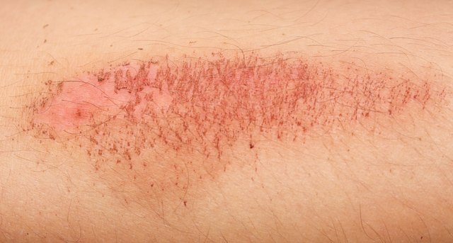 5 Things You Need to Know About Road Rash | Livestrong.com