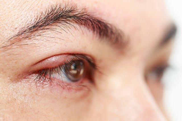 Right upper eye lid abscess "stye or hordeolum"
