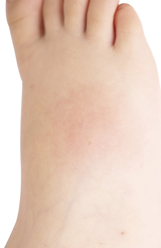 How To Reduce Feet Swelling With Oral Vitamins Livestrong
