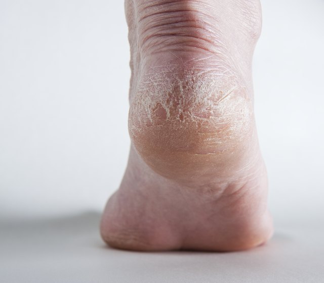 Cracked heel on human foot