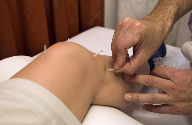 Acupuncture