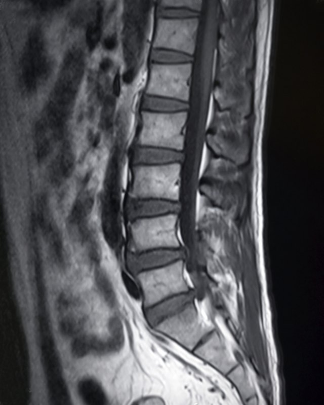 human lumbar vertebra magnetic resonance image(MRI)