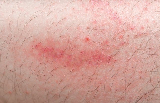 Red rush on leg skin.