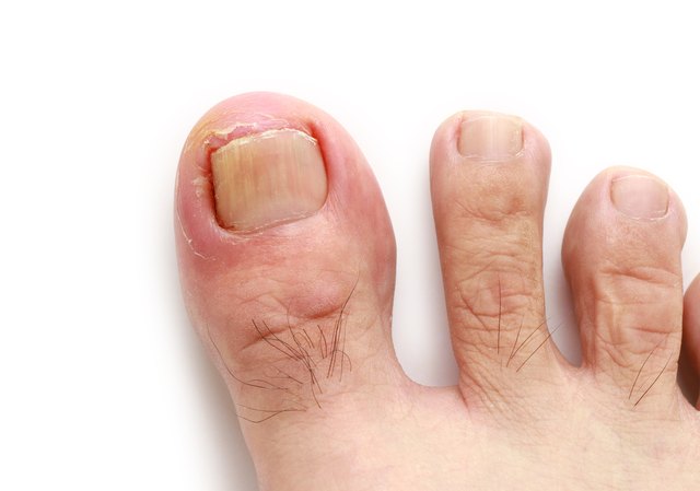 Ingrown toenail