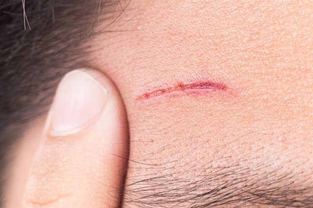 Finger embrace painful wound on forehead from deep cut