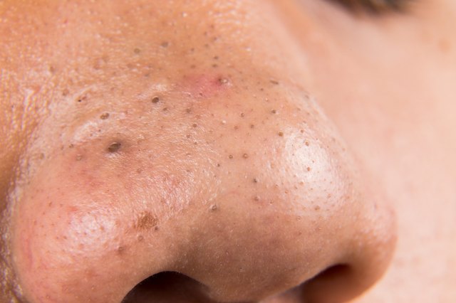 How To Remove Blackheads On The Nose