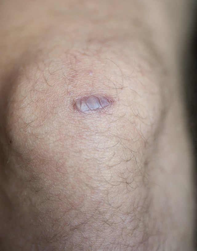 Keloid Scar