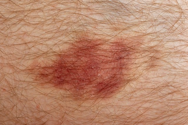 Nasty looking bruise on man's skin, macro