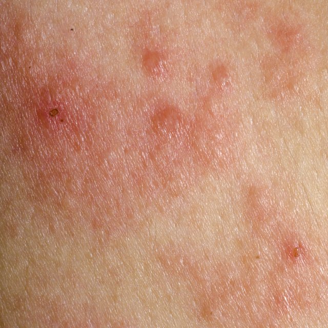 Over The Counter Treatments For Skin Rash