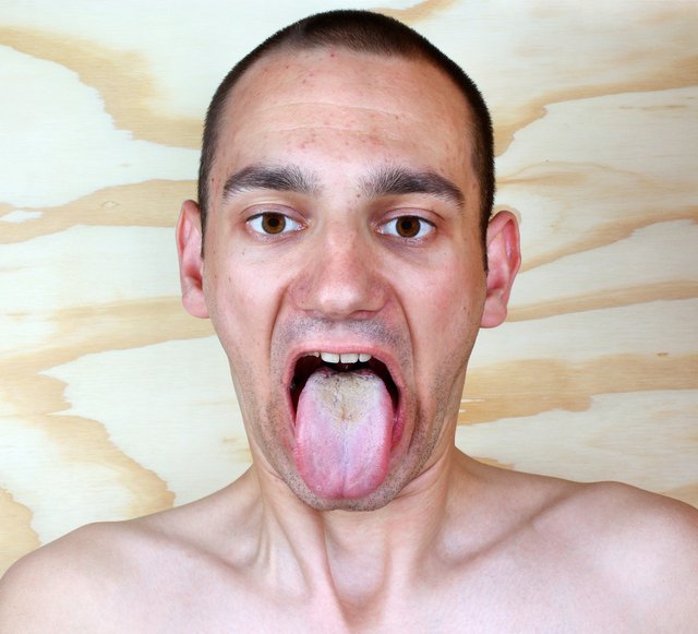 Infection tongue