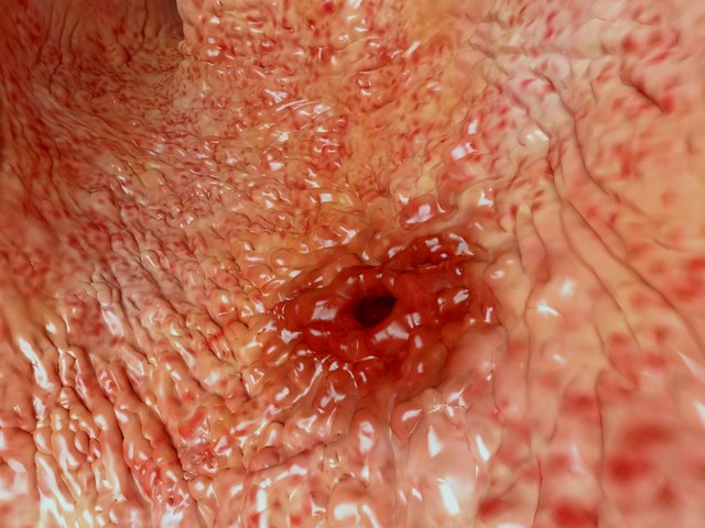 Peptic ulcer