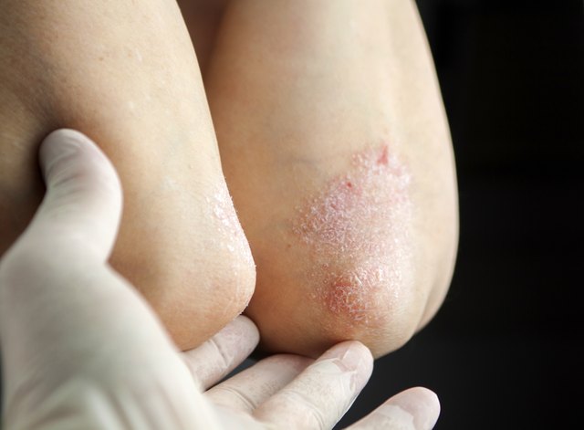 Psoriasis on elbows