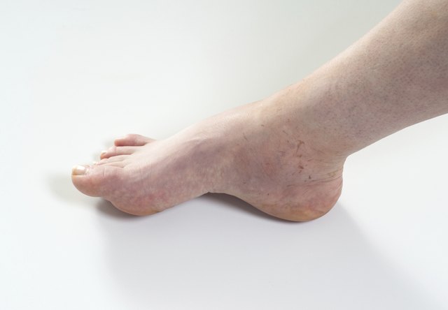 ankle sprain