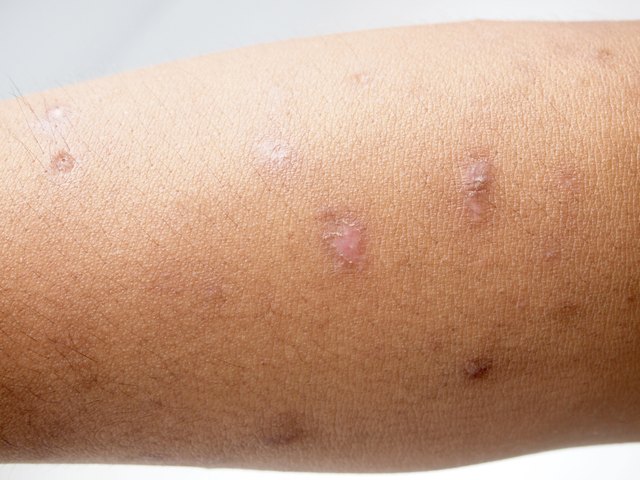 scar on the skin. macro