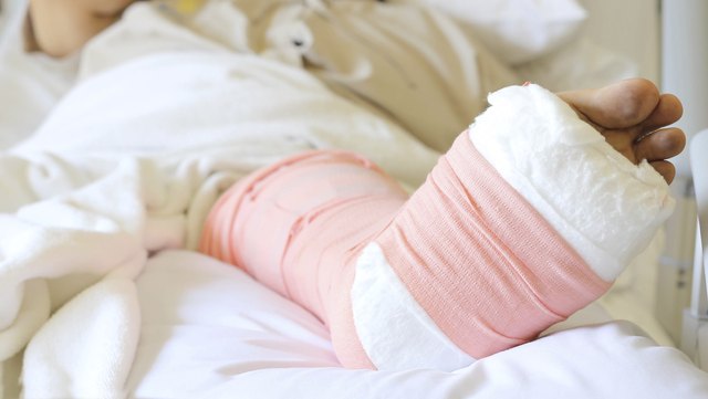 Foot splint for broken bones.