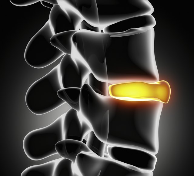 Disc ruptured in x-ray view - close up