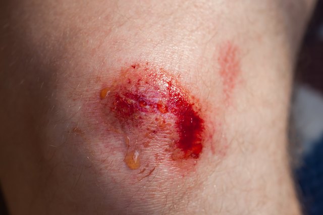 Broken bleeding knee