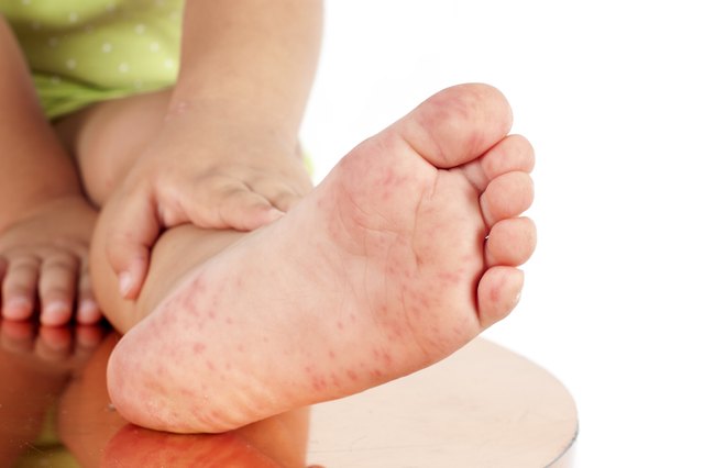 Folliculitis On Child's Foot