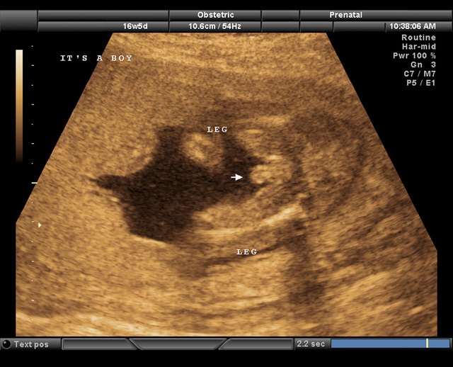 Ultra sound scan of fetus