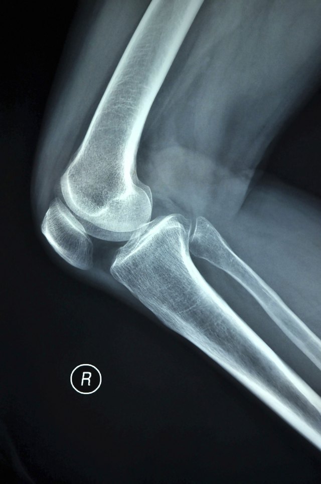 Knee Replacement Infection Symptoms | Livestrong.com