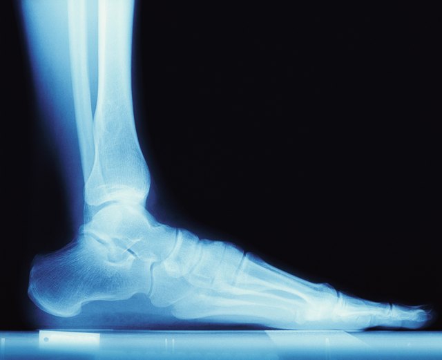 X Ray of a Human Foot